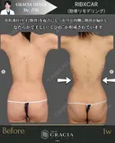 肋骨リモデリング after画像 サムネイル用