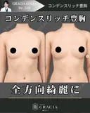 コンデンスリッチ豊胸 before画像 サムネイル用