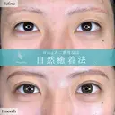 Wing式二重埋没自然癒着法 30日後 サムネイル用