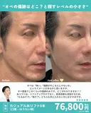 カジュアル糸リフト8本（口横・ほうれい線） before画像 サムネイル用