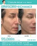 カジュアル糸リフト8本（口横・ほうれい線） after画像 サムネイル用