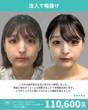 Vラインセット＋ぷっくりアイリップセット before画像 サムネイル用