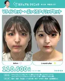 Vラインセット＋ぷっくりアイリップセット 30日後 サムネイル用
