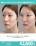 頬 ヒアルロン酸 before画像 サムネイル用