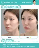 頬 ヒアルロン酸 after画像 サムネイル用