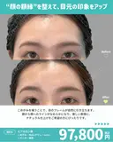 こめかみヒアルロン酸 before画像 サムネイル用