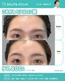 こめかみヒアルロン酸 after画像 サムネイル用