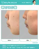 顎 ヒアルロン酸 after画像 サムネイル用