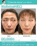 10minutesクマ治療 目の下 (ベビーコラーゲン1cc) 0日後 サムネイル用