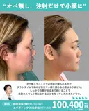 脂肪溶解注射(ｶﾍﾞﾘﾝ)24cc/エラボトックス80単位(ﾘｽﾞﾄｯｸｽ) before画像 サムネイル用