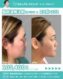 脂肪溶解注射(ｶﾍﾞﾘﾝ)24cc/エラボトックス80単位(ﾘｽﾞﾄｯｸｽ) 30日後 サムネイル用