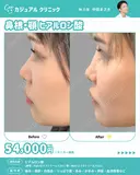 鼻根・顎ヒアルロン酸 after画像 サムネイル用