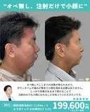 脂肪溶解注射(ｶﾍﾞﾘﾝ)24cc×3回/エラボトックス80単位(ﾘｽﾞﾄｯｸｽ) before画像 サムネイル用
