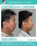 脂肪溶解注射(ｶﾍﾞﾘﾝ)24cc×3回/エラボトックス80単位(ﾘｽﾞﾄｯｸｽ) after画像 サムネイル用