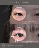 【タレ目形成】目尻切開＋タレ目形成 after画像 サムネイル用