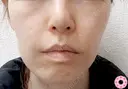エラ取り（ボトックス） 30日後 サムネイル用
