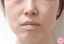 エラ取り（ボトックス） before画像 サムネイル用
