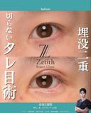 埋没二重と切らないタレ目術を受けられた方です。 before画像 サムネイル用