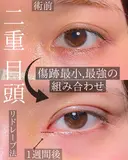 目頭切開　二重埋没 after画像 サムネイル用