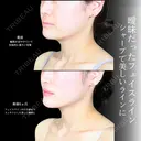 頬・顎下脂肪吸引/ジョールファット/バッカルファット/エラボトックス/糸リフト before画像 サムネイル用