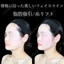 頬・顎下脂肪吸引/ジョールファット/バッカルファット/エラボトックス/糸リフト 180日後 サムネイル用