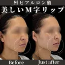 唇ヒアルロン酸 before画像 サムネイル用