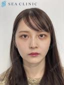 ３D脂肪吸引(頬・顎下)/ジョールファット/糸リフトアップ/脂肪注入(頬) 80日後 サムネイル用