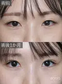 二重埋没　裏シークレットダブルループ before画像 サムネイル用
