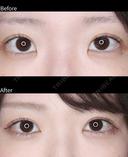目頭切開 before画像 サムネイル用