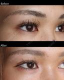 目頭切開・目尻切開 before画像 サムネイル用