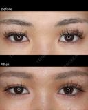 目頭切開・目尻切開 after画像 サムネイル用
