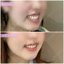 ガミースマイル治療（ボトックス・切開） before画像 サムネイル用