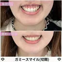 ガミースマイル治療（ボトックス・切開） 30日後 サムネイル用