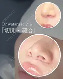 切開施術（人中短縮・眉下切開・） after画像 サムネイル用