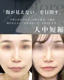 切開施術（人中短縮・眉下切開・） before画像 サムネイル用