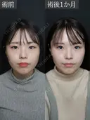 二重埋没　裏シークレットダブルループ after画像 サムネイル用