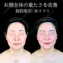 頬・あご下脂肪吸引 /糸リフト/バッカルファット/エラボトックス 180日後 サムネイル用