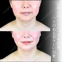 頬・あご下脂肪吸引 /糸リフト/バッカルファット/エラボトックス before画像 サムネイル用