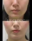 エラボトックス before画像 サムネイル用