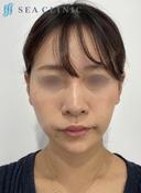 SEAライン ‐３D脂肪吸引（頬・顎）‐・ジョールファット・糸リフト・目の下のクマ取り・脂肪注入(目の下) 90日後 サムネイル用
