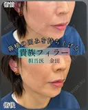 貴族フィラー（小鼻横の凹みに対するヒアルロン酸注入） before画像 サムネイル用