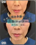 貴族フィラー（小鼻横の凹みに対するヒアルロン酸注入） after画像 サムネイル用