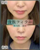 貴族フィラー（小鼻横の凹みに対するヒアルロン酸注入） before画像 サムネイル用