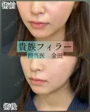 貴族フィラー（小鼻横の凹みに対するヒアルロン酸注入） after画像 サムネイル用