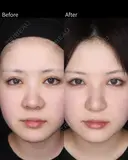 鼻尖形成・耳珠軟骨移植・小鼻縮小 before画像 サムネイル用