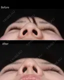 鼻尖形成・耳珠軟骨移植・小鼻縮小 after画像 サムネイル用