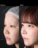 鼻尖形成・耳介軟骨移植・小鼻縮小・人中短縮 after画像 サムネイル用