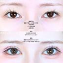 眼瞼下垂(たるみ取り併用)/目尻切開/タレ目形成術/皮膚切除 before画像 サムネイル用