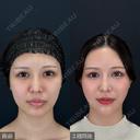 小顔脂肪吸引 before画像 サムネイル用
