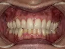 医療オフィスホワイトニング＋エアフロー＆歯石・歯垢除去 before画像 サムネイル用